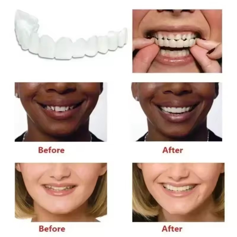 Teeth Veneers Whitening Dentur - огляд і ціна Teeth Whitening With Braces