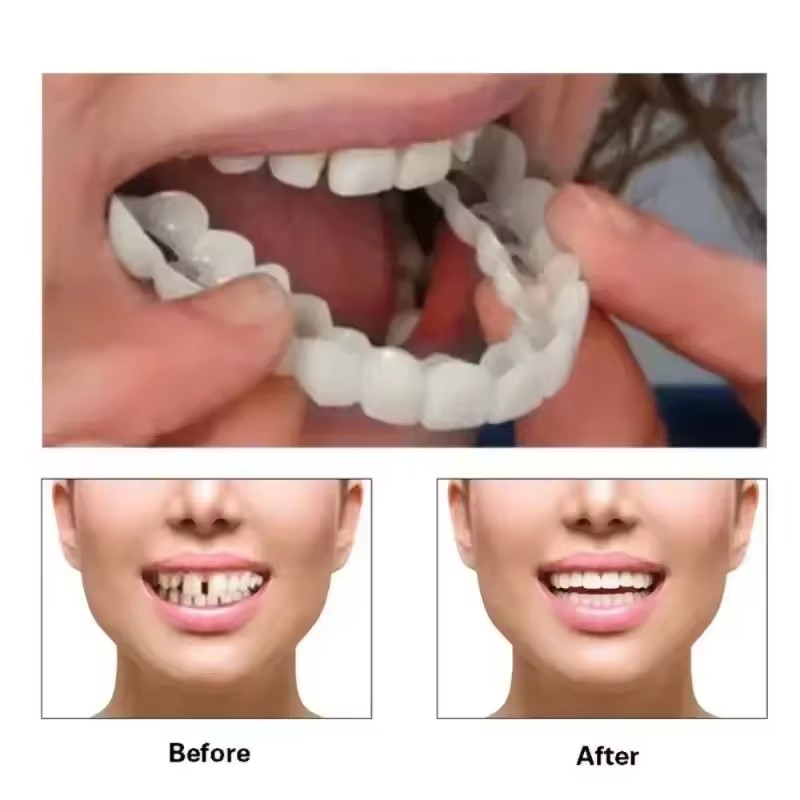 Teeth Veneers Whitening Dentur - огляд і ціна Teeth Whitening With Braces
