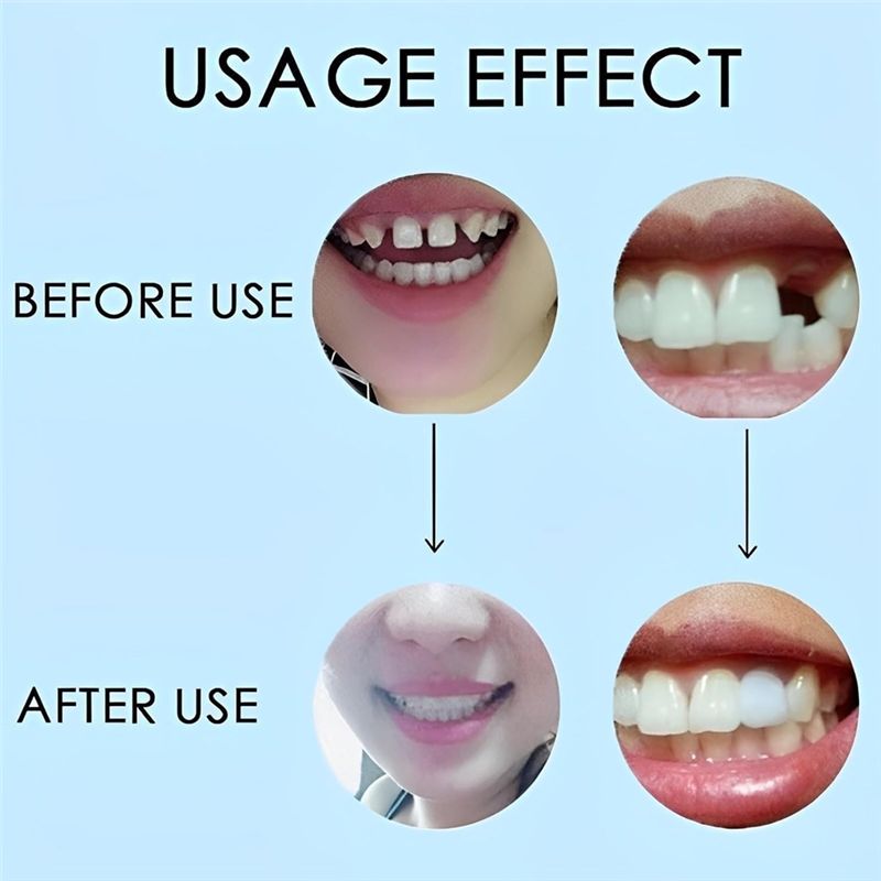 [NEW!ABMK】 2 Pairs,Regain Beau - огляд і ціна Teeth Whitening With Braces